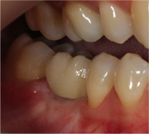 Implante Dentário - Depois
