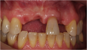 Implante Dentário - Antes
